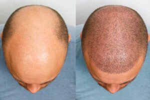 A Man’s Guide To Hair Replacement Systems